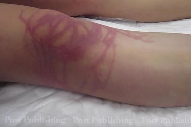 jellyfish sting kills german woman on samui bangkok post learning