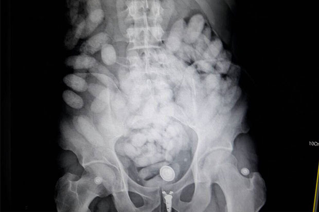 An x-ray film shows heroin inside the stomach of Paulo Nascimento (Narcotics Suppression Bureau photos)