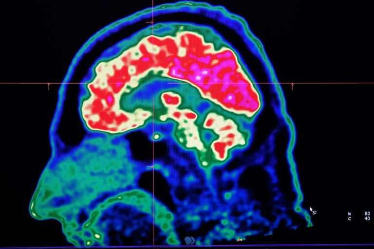 A new study honed in on the brain circuitry responsible for upgrading or downgrading pain signals, likening the mechanism to how a home thermostat controls room temperature A new study honed in on the brain circuitry responsible for upgrading or downgrading pain signals, likening the mechanism to how a home thermostat controls room temperature