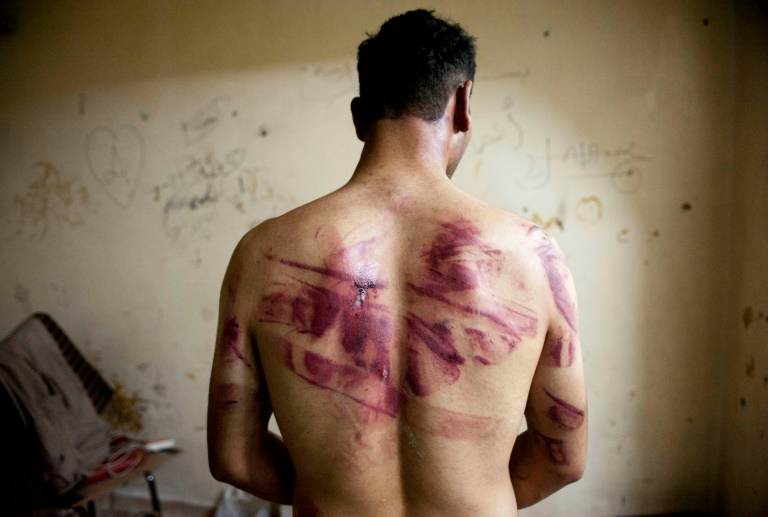 A Syrian man shows torture marks on his back after he was released from regime forces in the northern city of Aleppo. A Syrian man shows torture marks on his back after he was released from regime forces in the northern city of Aleppo.