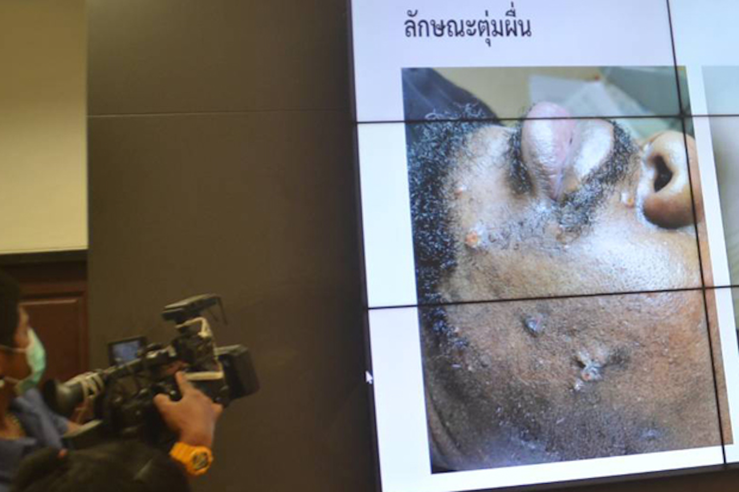 The symptoms on the face of the Nigerian monkeypox patient are displayed on a slide during a media briefing in Phuket on Friday. (Photo: Achadtaya Chuenniran)