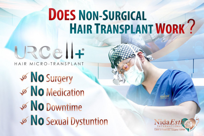 Does Non-surgical Hair Transplant Work? By Dr. Piya - Vimarsana News