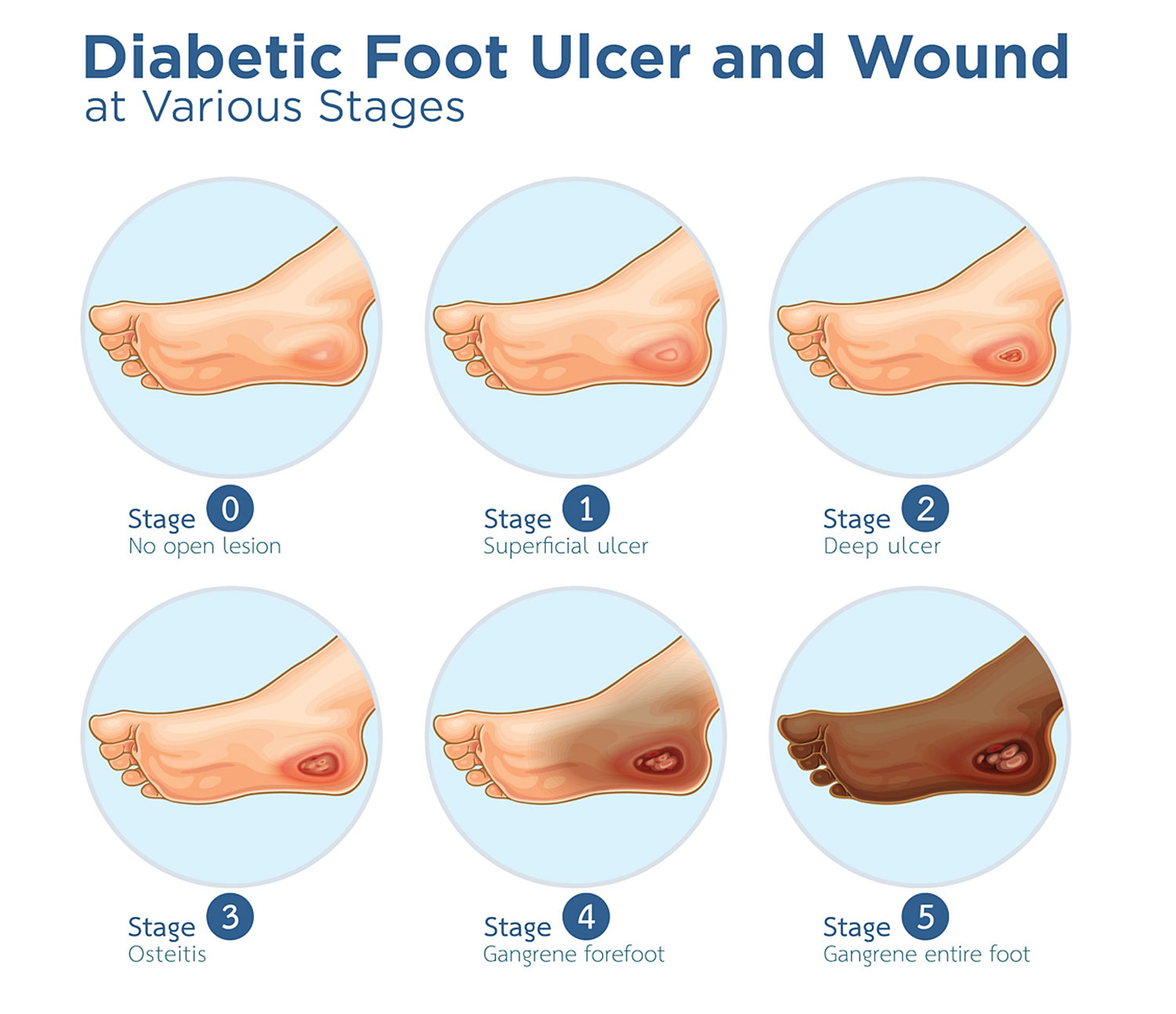 Diabetic Foot Ulcer Diabetic Foot Ulcer