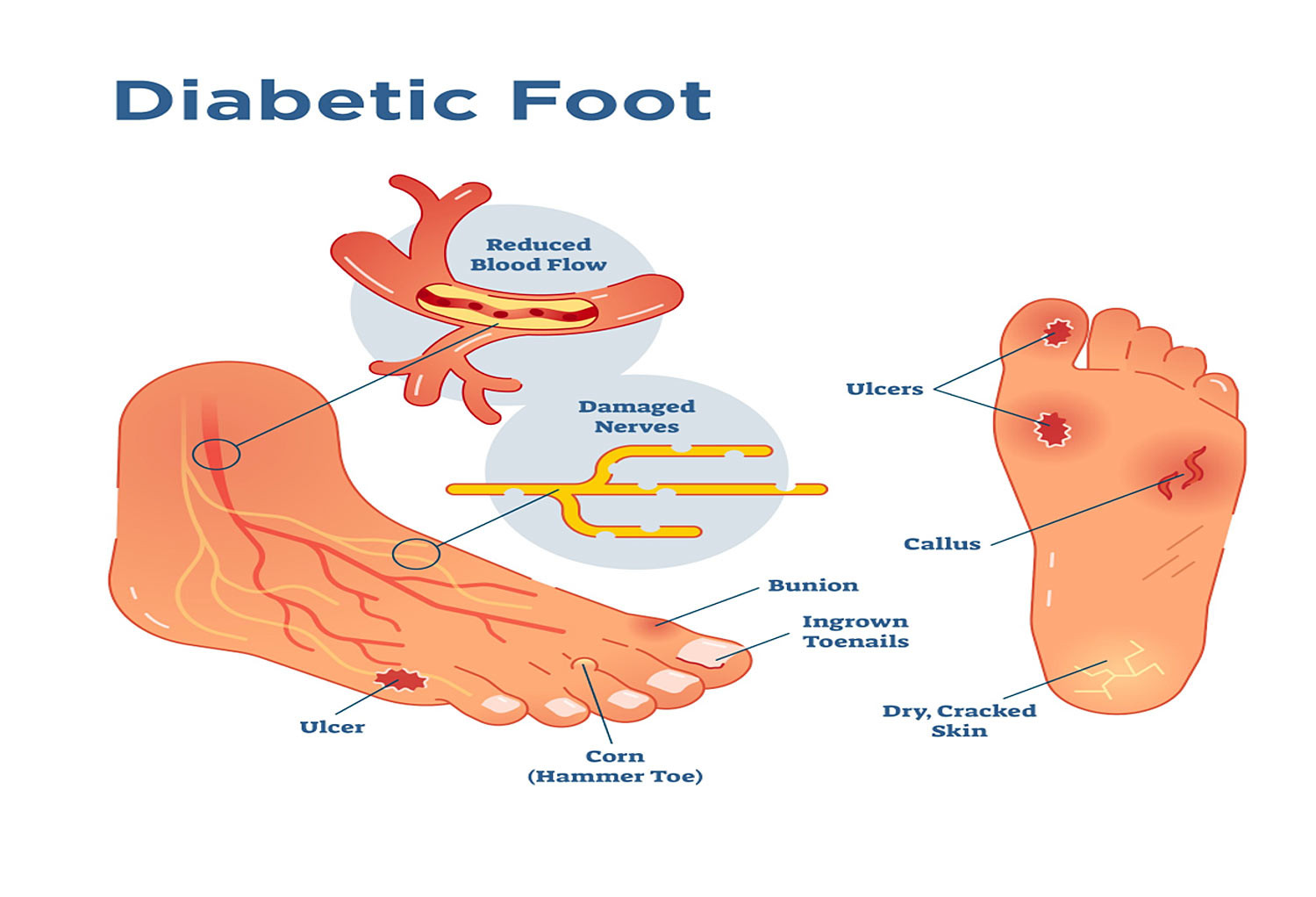 Bangkok Post Understanding Diabetic Foot Ulcers Bangkok Post Understanding Diabetic Foot Ulcers