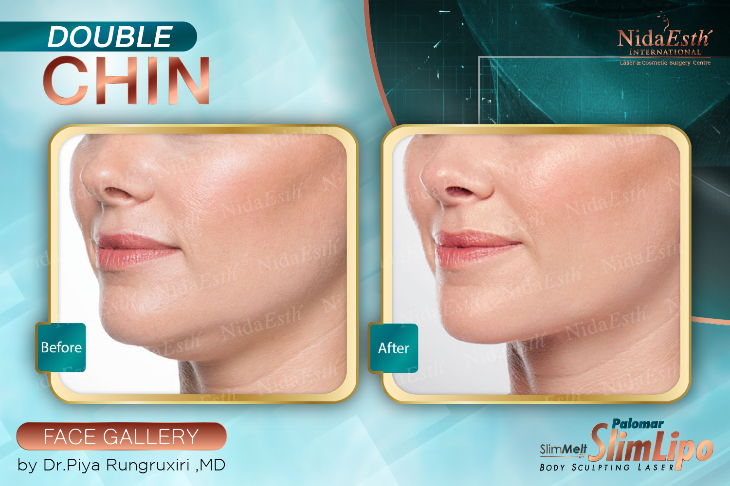 Bangkok Post Lipo+Lift2 The Micro Laser Surgery Neck Lift For