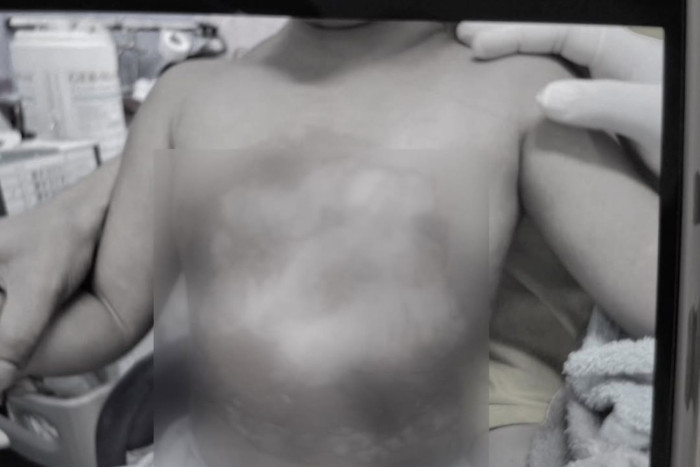 Clinic probed after feverish toddler scalded