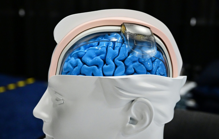 Are brain implants the tech of the future? Some think neurotech could be as revolutionary as AI. (Photo: AFP)