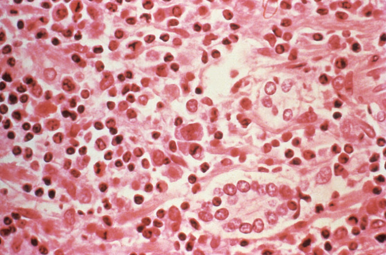 Two cases of hantavirus which spreads human-to-human linked to ship, South Africa says