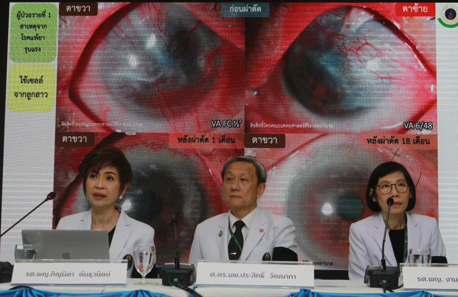 Siriraj Hospital director Prasit Watanapa, centre, and ophthalmologists Assoc Prof Pinnita Tanthuvanit, left, and Assoc Prof Ngamkae Ruangvaravate speak at a press conference declaring stem cell transplants have successfully restored the sight of 75 partially and completely blind patients. (Photo by Pawat Laopaisarntaksin)